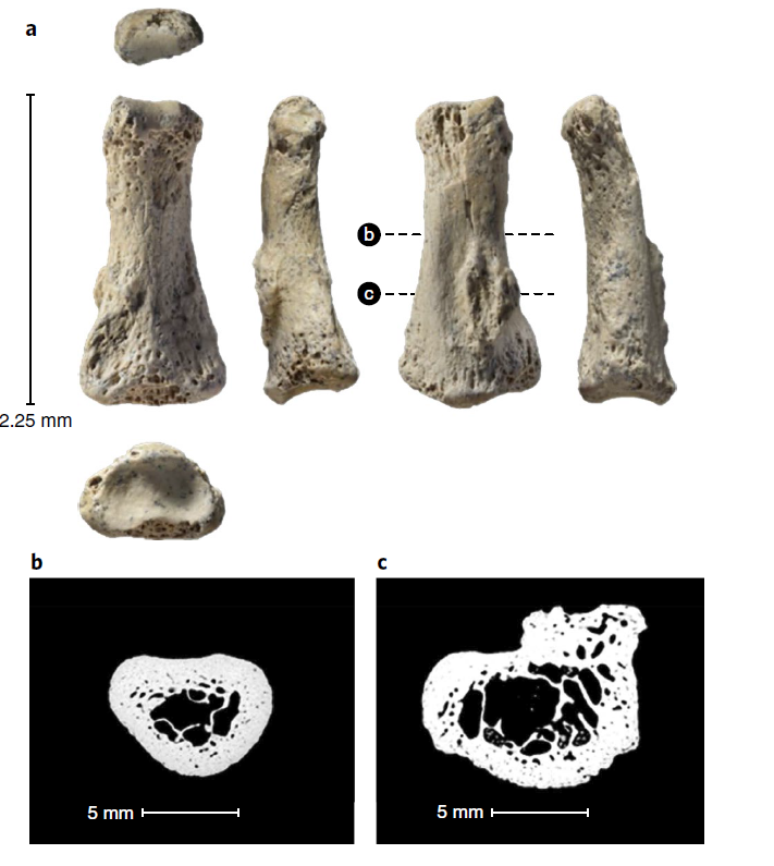 Al Wusta finger bone photographs and CT cross-sections showing enthesophyte marked C